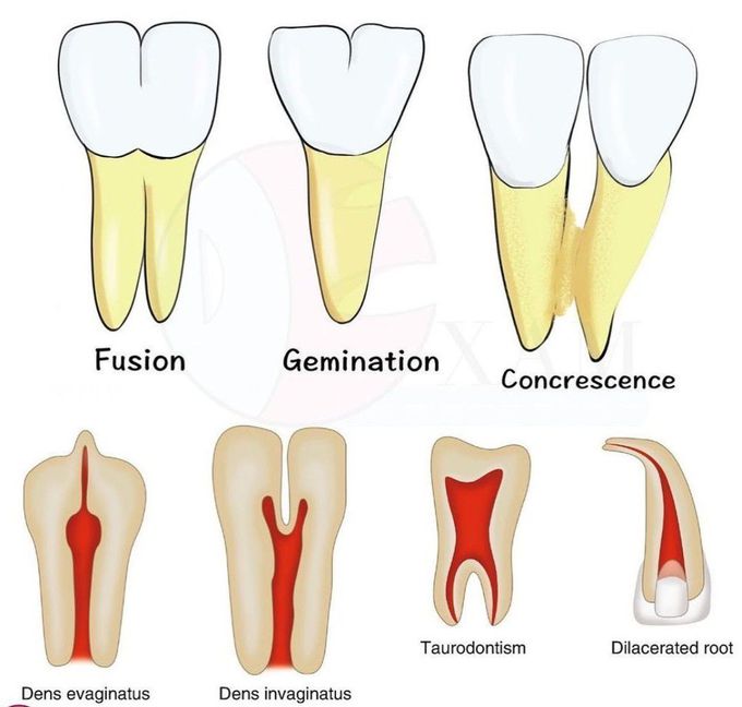 Tooth Abnormalities