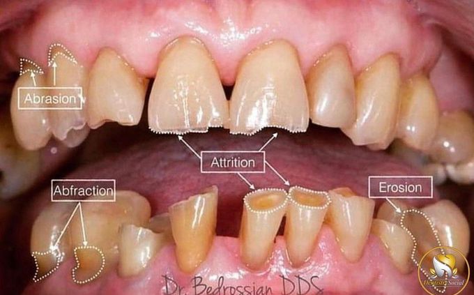 Non carious dental lesions