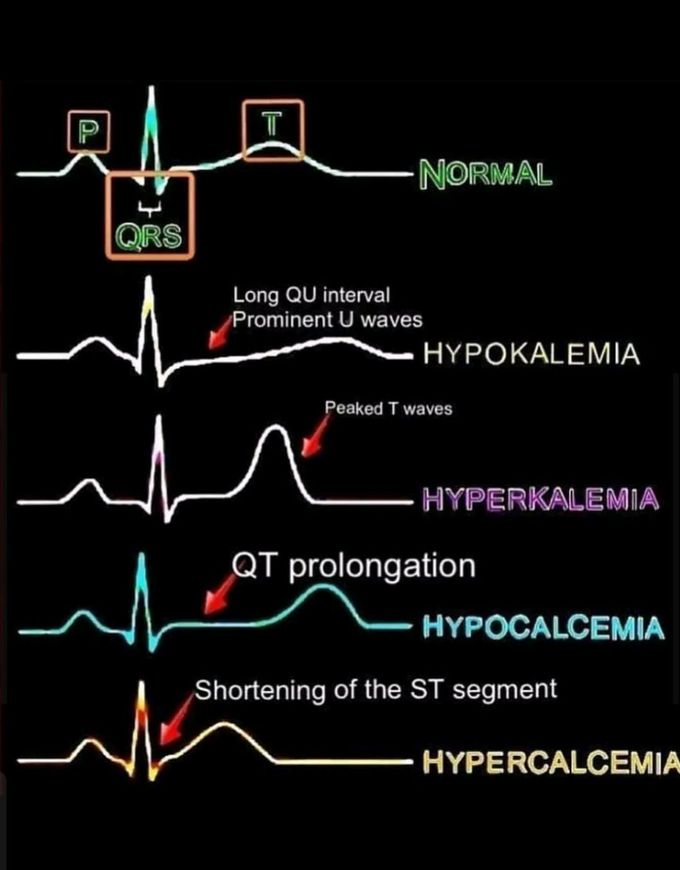 ECG changes
