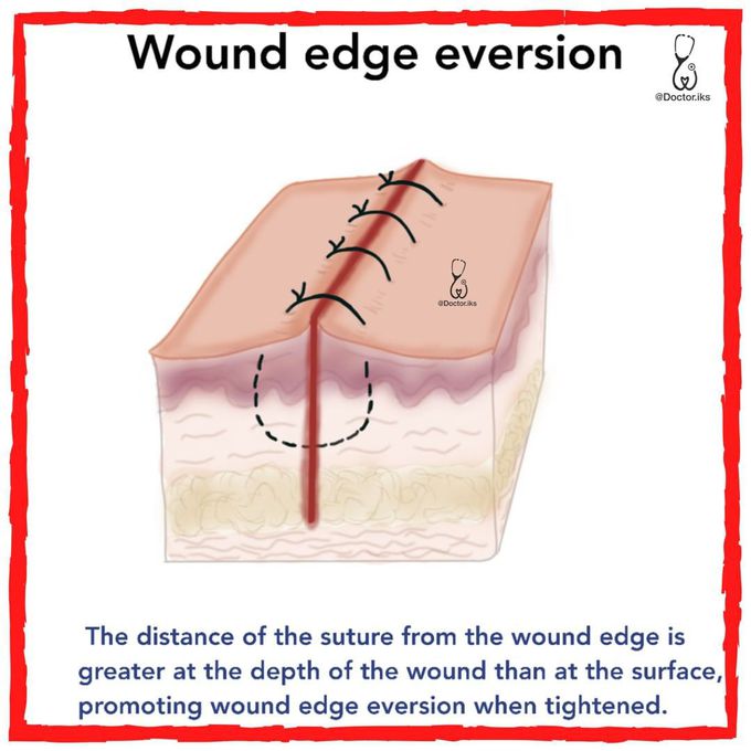 Wound Edge Eversion