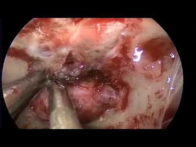 Endoscopic Endonasal Approach for Tuberculum Sellae Meningioma