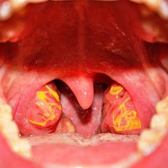 Tangier disease