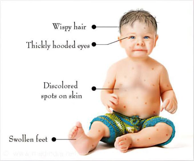 Treatment of Noonan syndrome