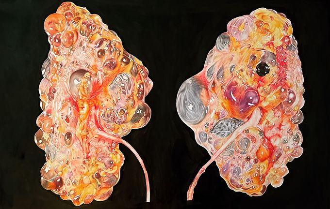 Illustration of kidneys from a person with polycystic kidney disease