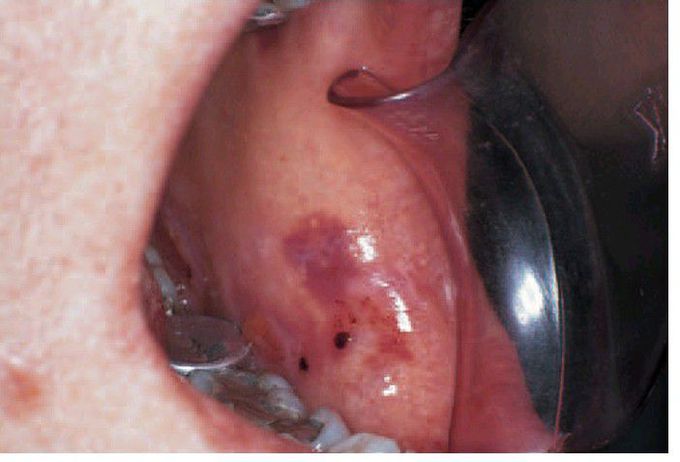 Purpura