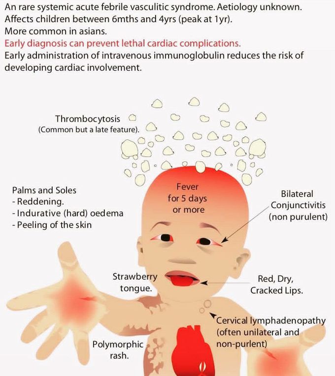 KAWASAKI DISEASE