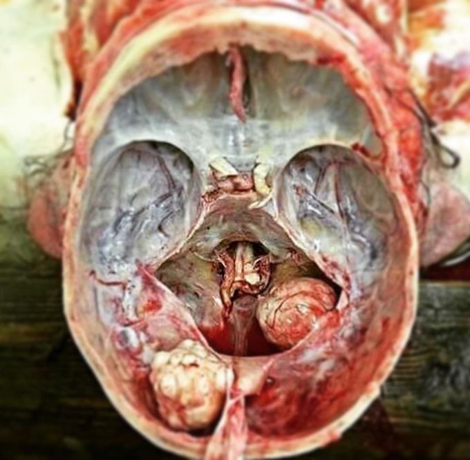 Have you ever seen an opened skull before? 