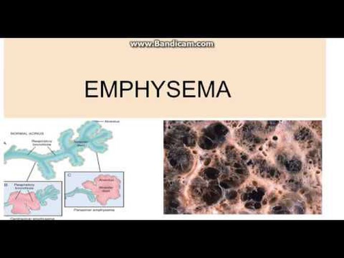 Introduction to Emphysema