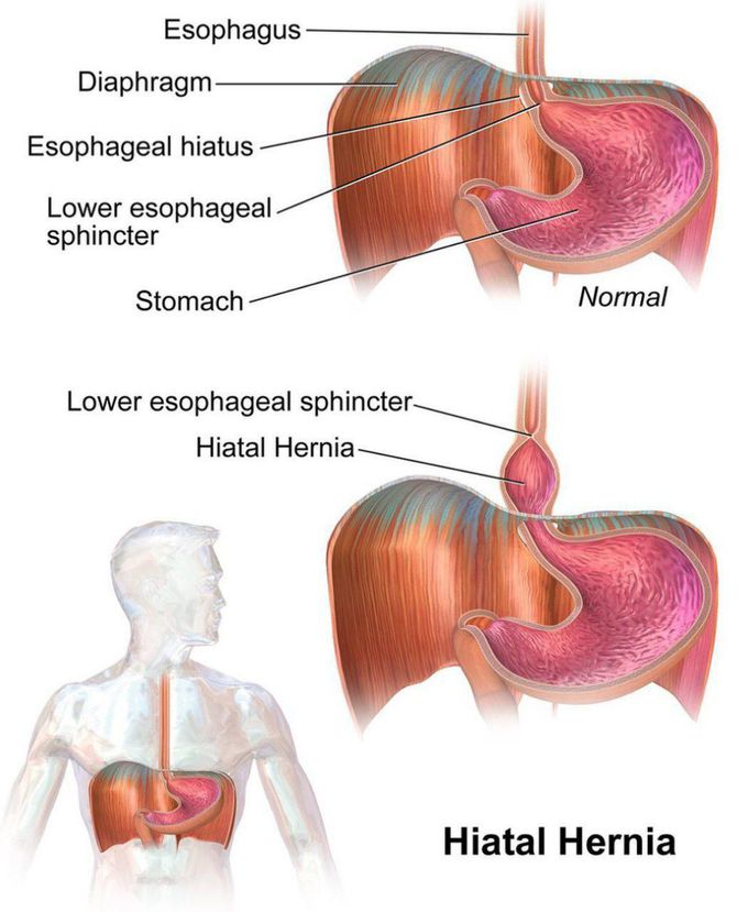 Hiatal hernia