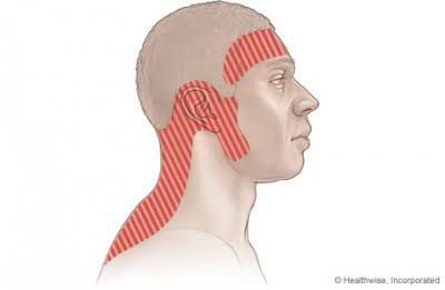 Tension type headache - MEDizzy