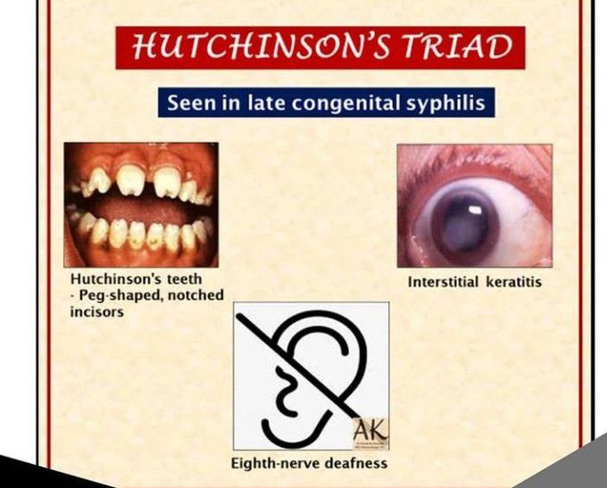 Hutchison's triad