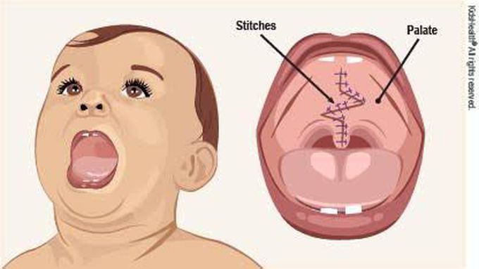 Symptoms of cleft palate