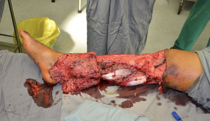 Insane degloving trauma injury of the lower leg..