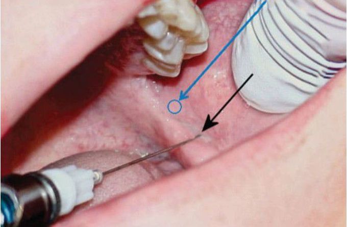 Inferior Alveolar Nerve Block