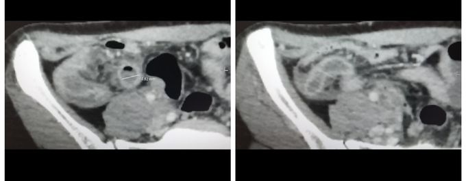 Acute appendicitis