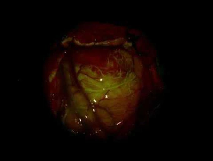 Intravenous Administration of Fluorescein in Brain-Tumor Surgery