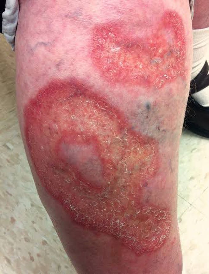Necrobiosis lipoidica diabeticorum