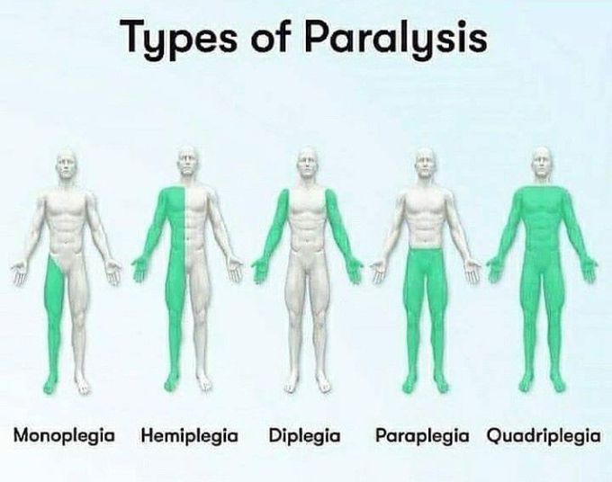 Types of paralysis