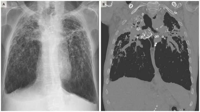 Chronic Silicosis with Progressive Massive Fibrosis