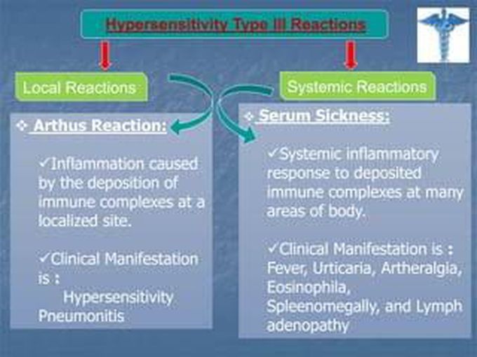 Arthus Reaction and Serum Sickness