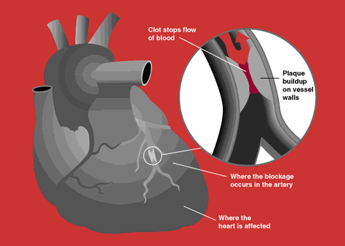 initial-therapy-for-acute-coronary-syndrome-medizzy