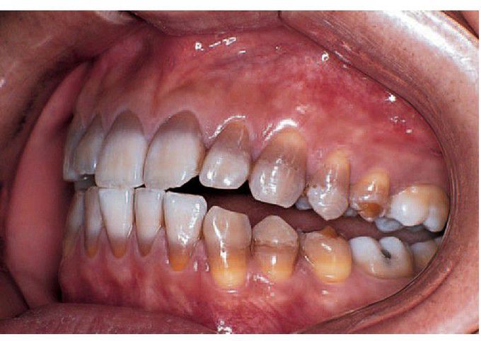 Tetracycline staining