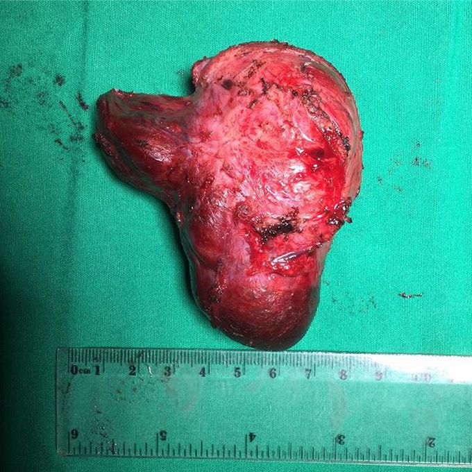 Istmolobectomy