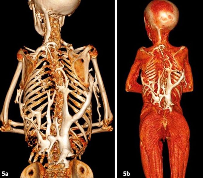 The stone man disease: fibrodysplasia ossificans progressiva: imaging revisited