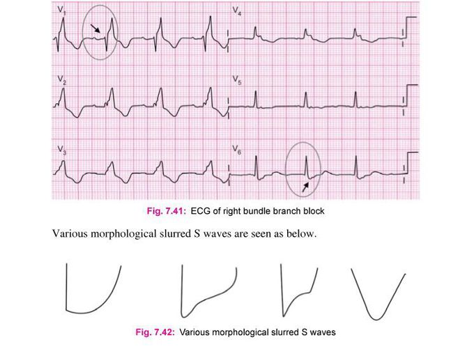 According to previous post  of how to dx RBBB ,this ECG of case RBBB.