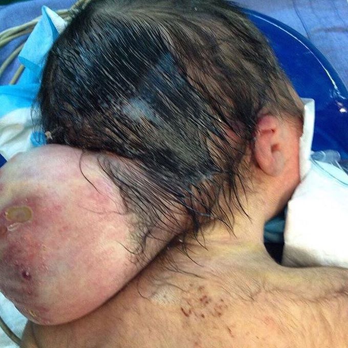 Cervical meningocele