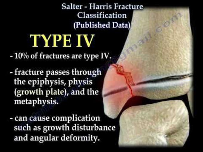 Fractures-Salter Harris Classification