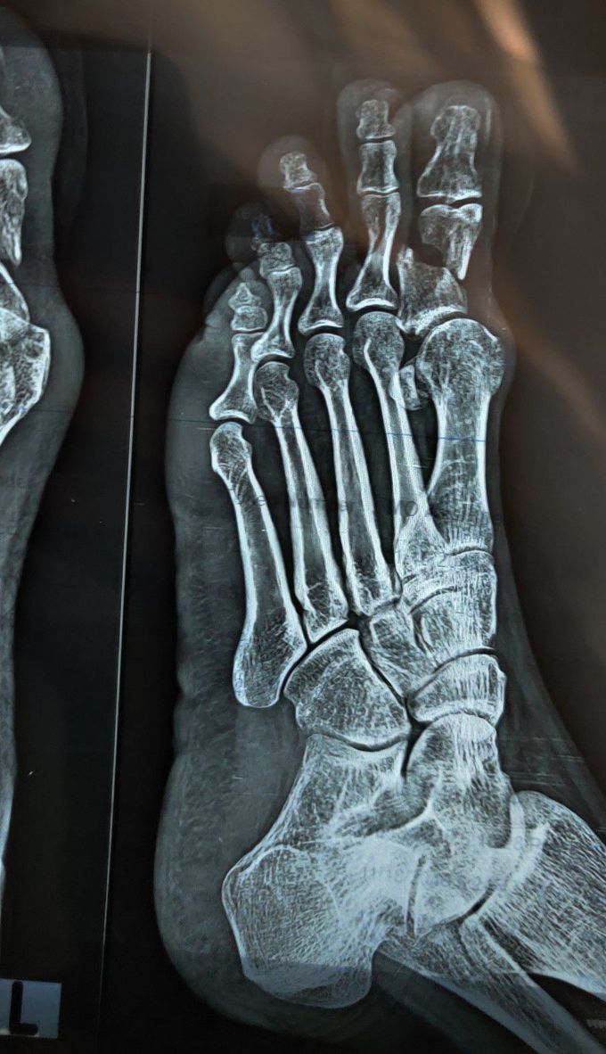 Fracture 1st proximal phalanx of left foot - MEDizzy