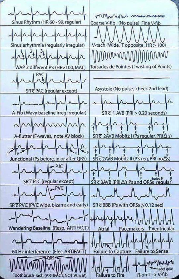 #ECG