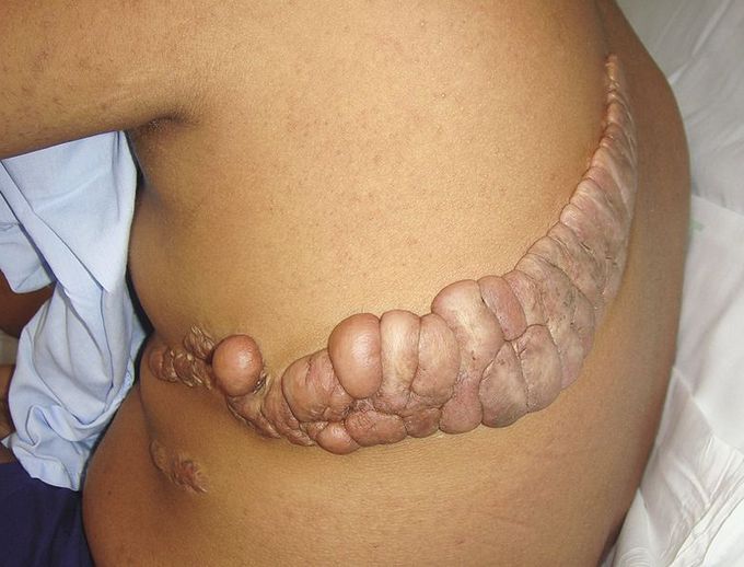 Incisional Keloid