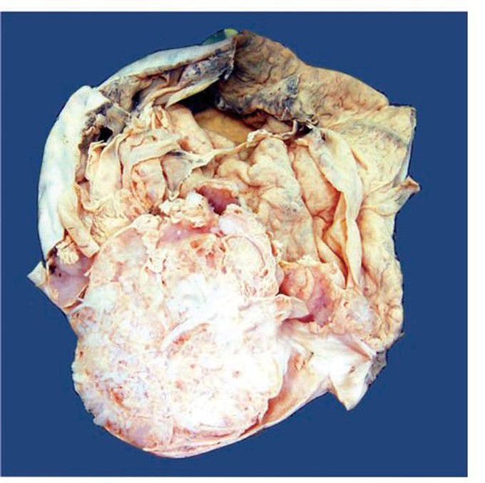 Mucinous cystadenoma of the ovary.