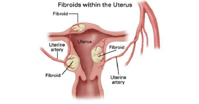Red degeneration of Fibroids