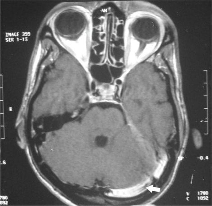 Lateral Sinus Thrombosis