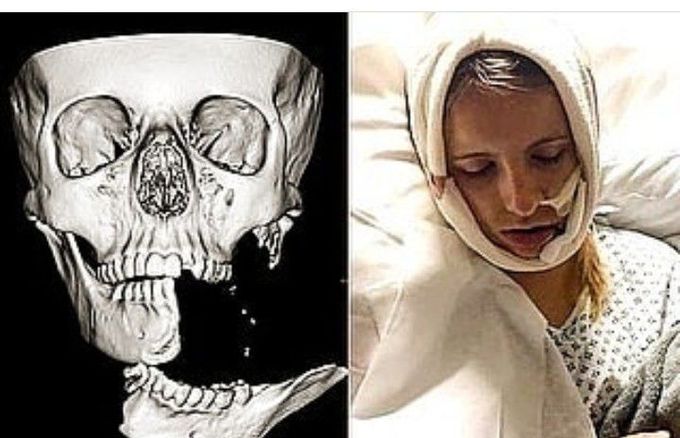 The skull after a devastating horse kick injury