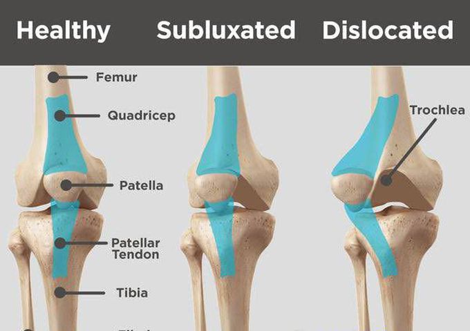 Patellar subluxation