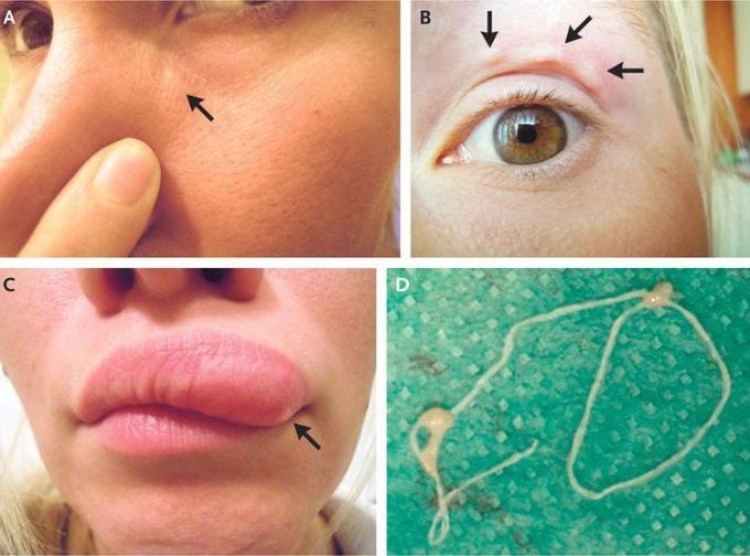 An odd lump on a woman's face turned out to be a worm