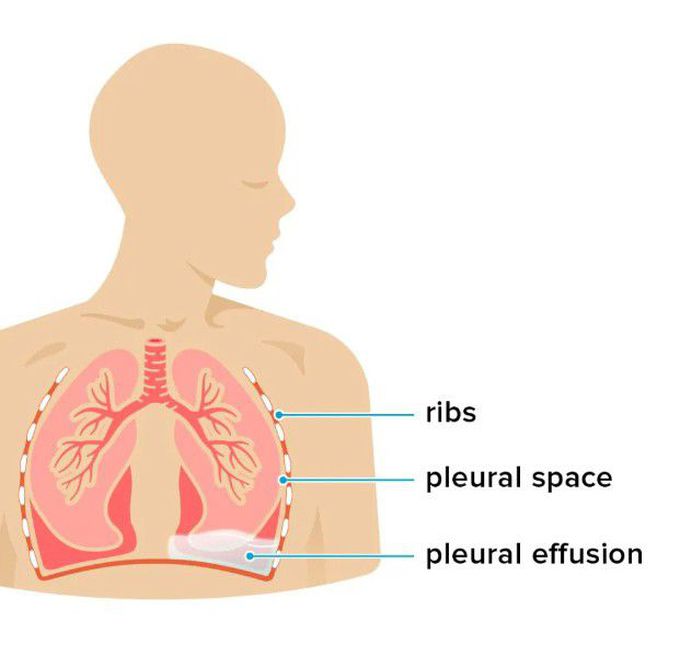 Symptoms of pleural effusion