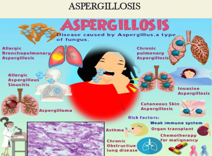 Aspergillosis