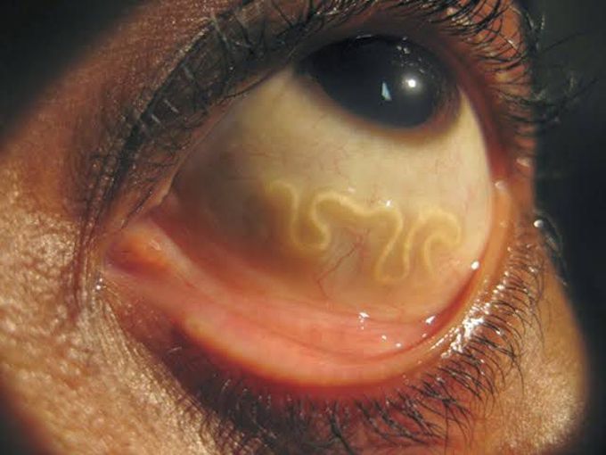 Raccoon Roundworm / Baylisascaris Infection