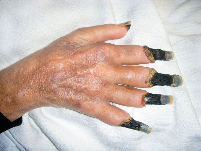Gangrene
