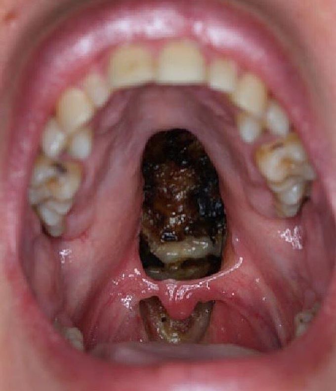 Palatal perforation with nasopharyngeal infection due to excessive cocaine use! 