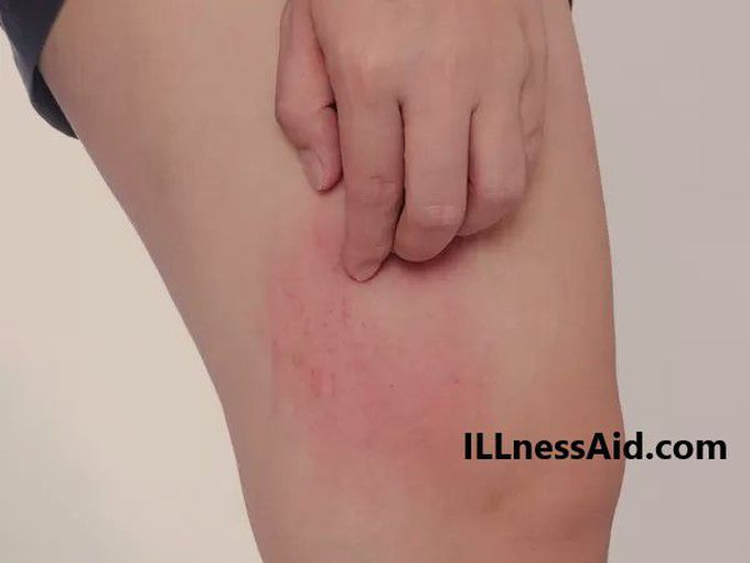 Home Remedies For Chafing: How To Soothe Irritated Skin - ILLnessAid