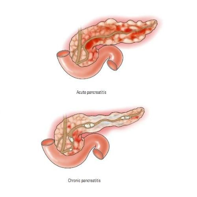 Types of Pancreatitis