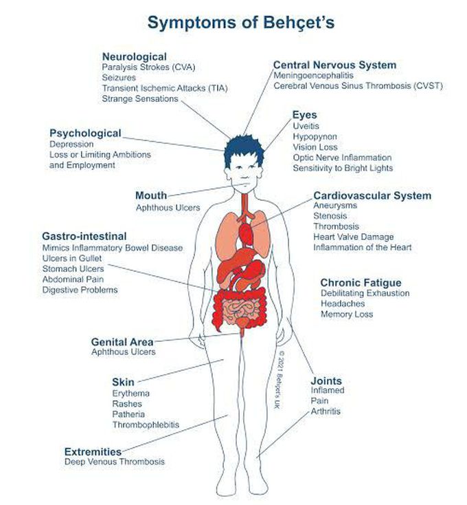 These are the main symptoms of Behcet syndrome
