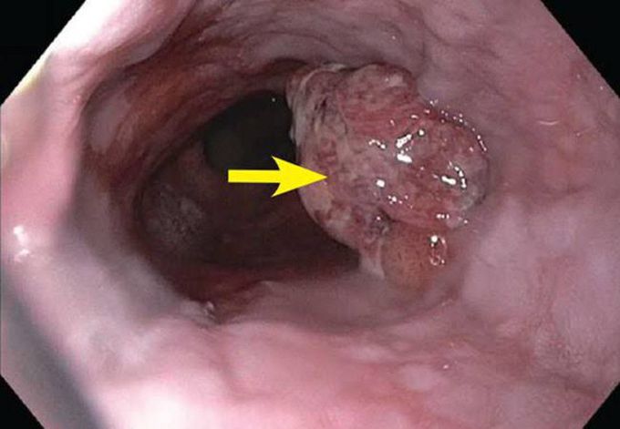 Adenocarcinoma of Esophagus