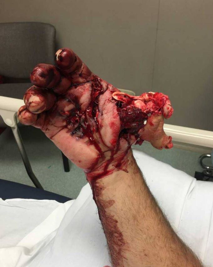 This patient suffered a massive injury from a hunting related-accident